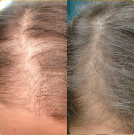 Antes e depois Fernanda 41 anos - Kit SOS Crescimento